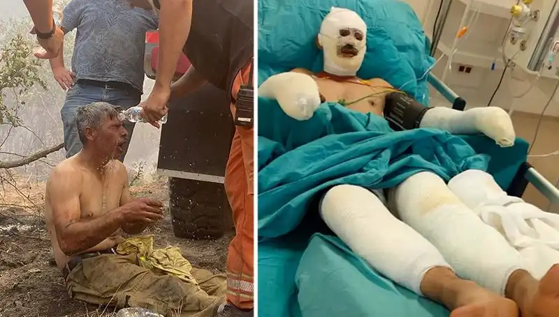 Yanıyorum Diyerek Feryat Eden Orman İşçisinde Gelişmeler: Tedavi Süreci Devam Ediyor