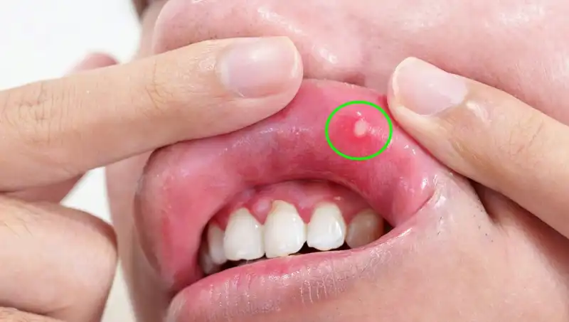 B Vitaminleri Eksikliğinde Dikkat Edilmesi Gereken 5 Belirti