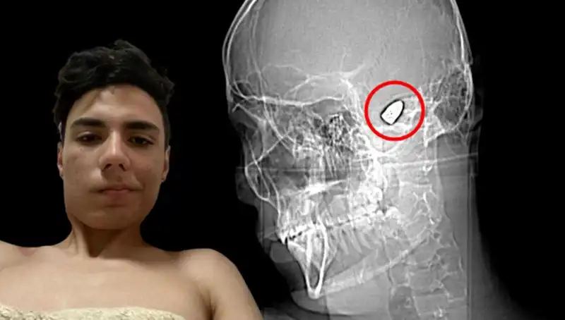 Kafasında Patlamaya Hazır Bomba Taşıyan Genç: Yaşadığı Korkunç Gerçekler
