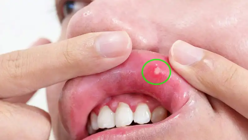 Dilinin Alınması Gereken Bir Adam: Kanserin Uyarı İşareti Görmezden Gelindi